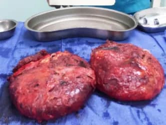 Two en bloc specimens after surgery, each implant still sealed inside its capsule