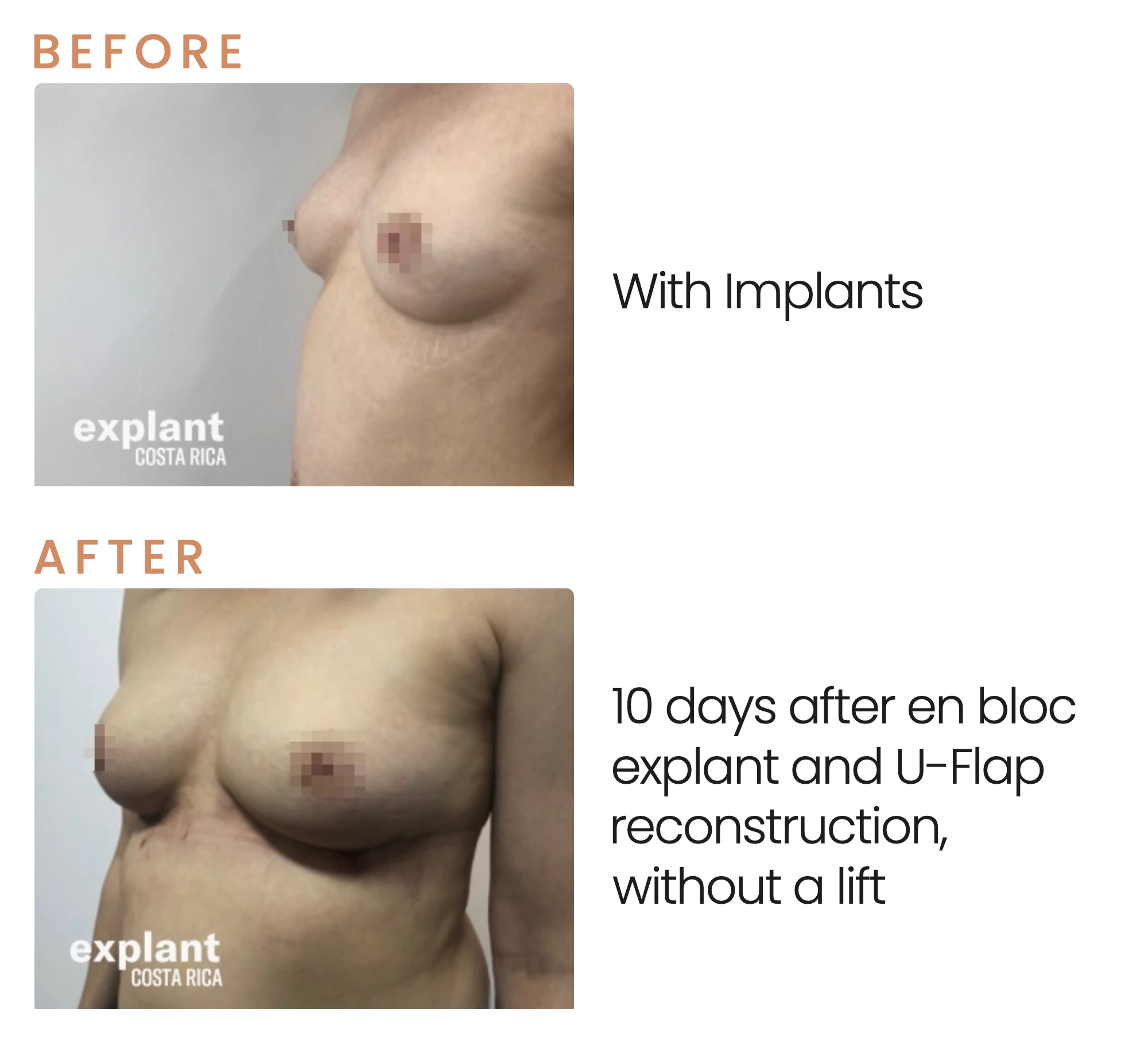 Explant result, before and after