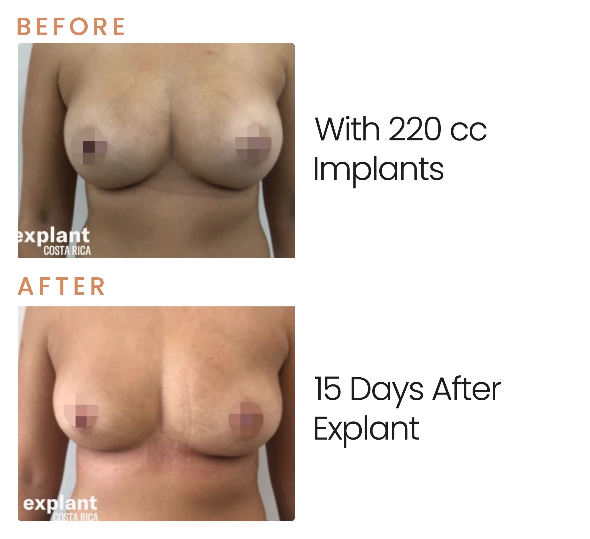 Explant result, before and after