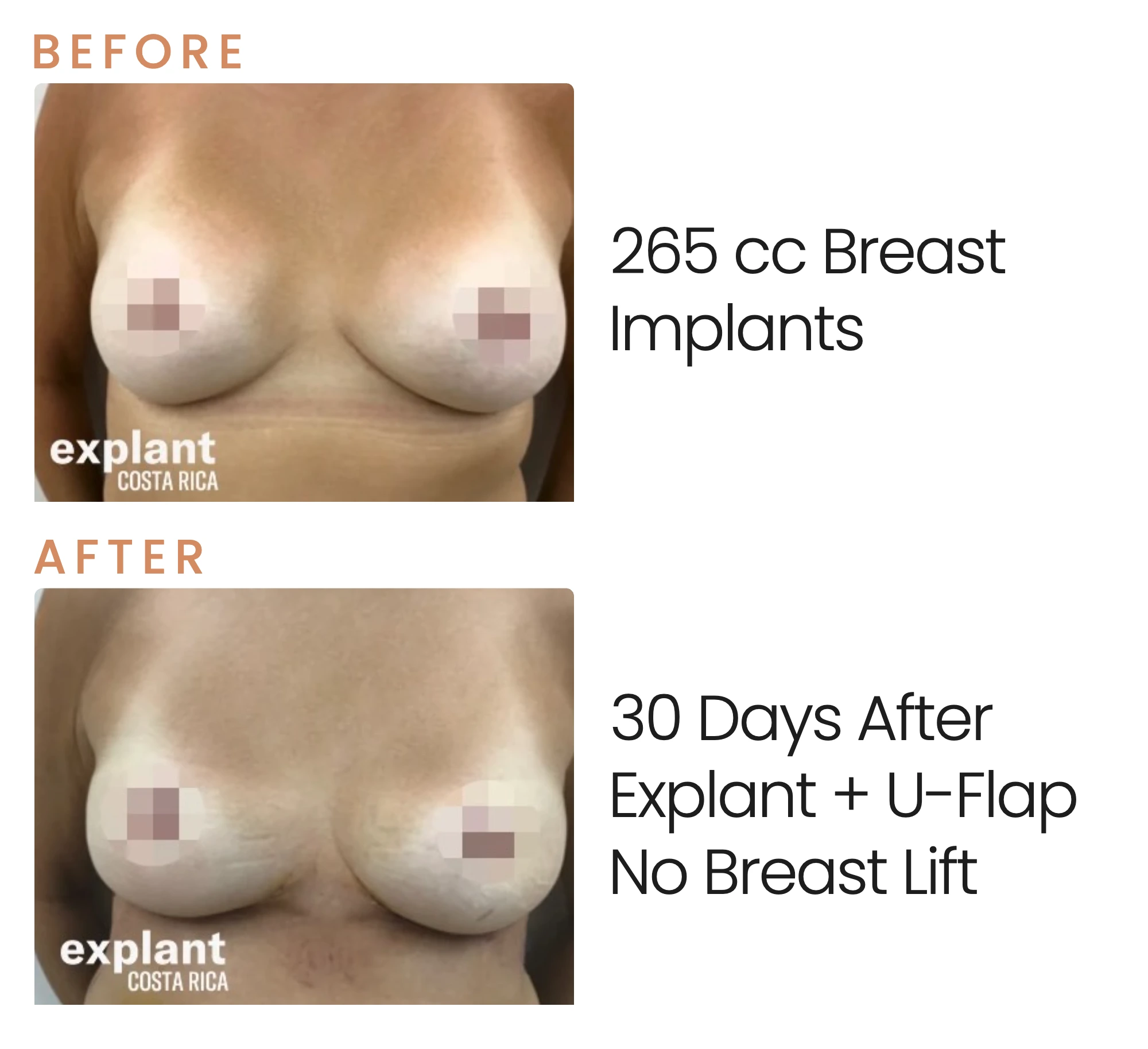 Explant result, before and after