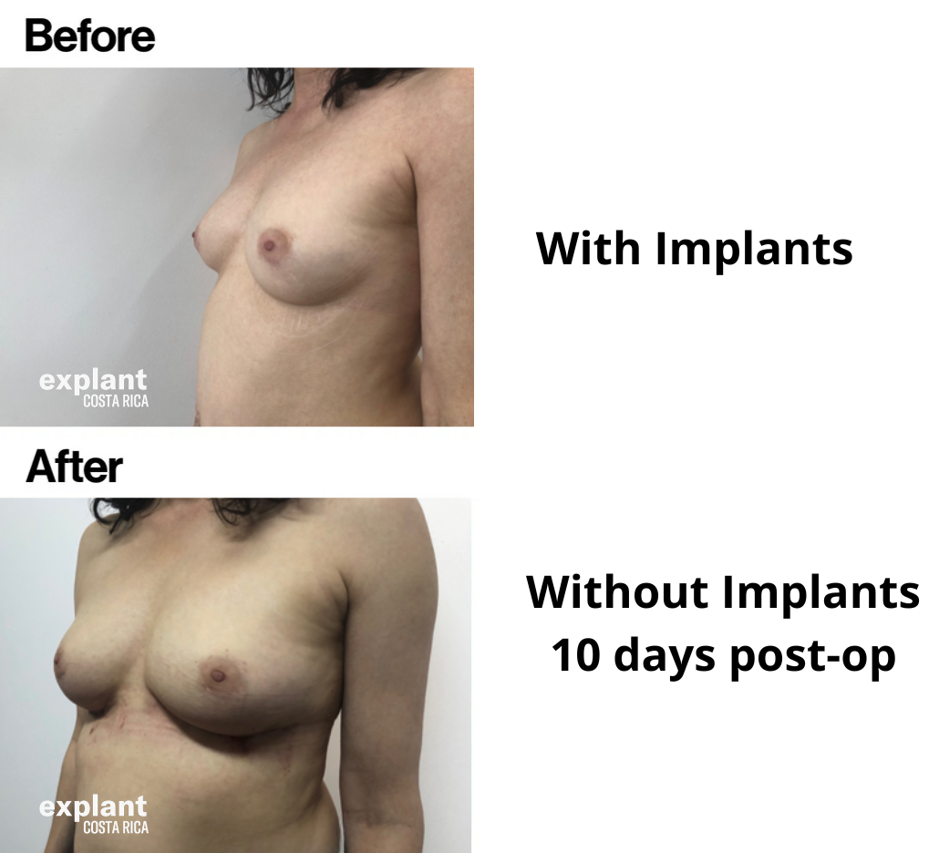 Explant result, before and after
