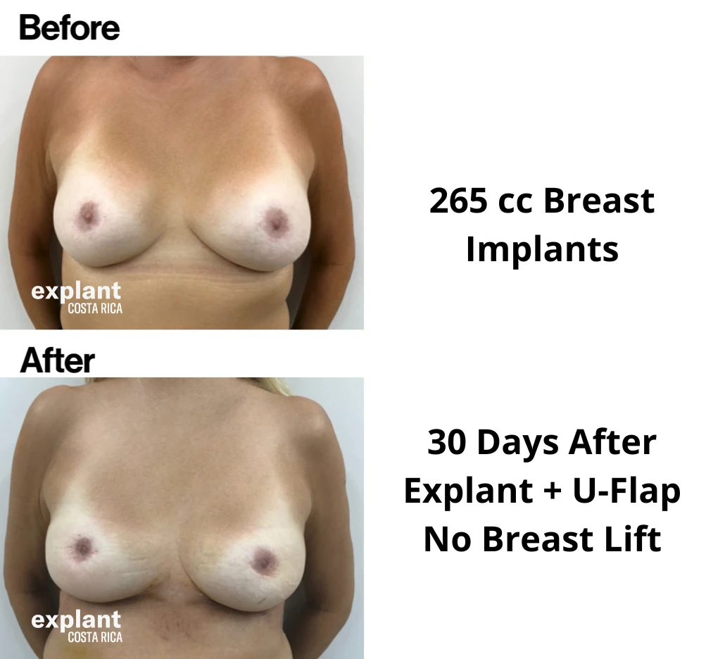 Explant result, before and after
