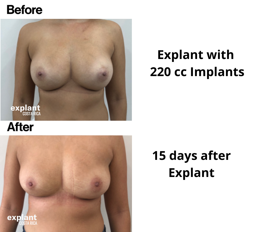 Explant result, before and after